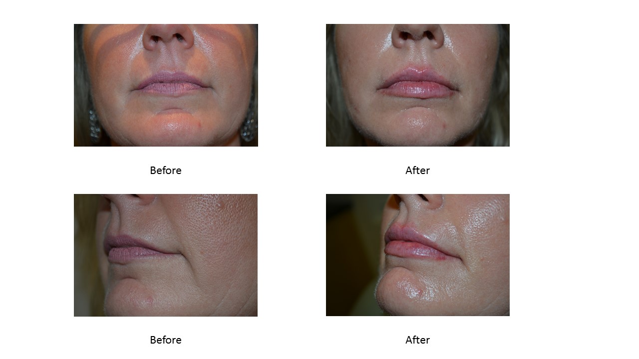 volbella lips define syringe xc juvederm cost juvéderm take injectable promotions advantage specials sure always current