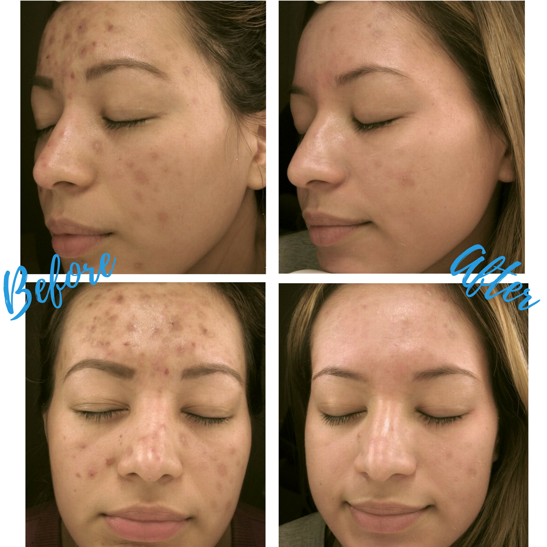 Facials sales for acne