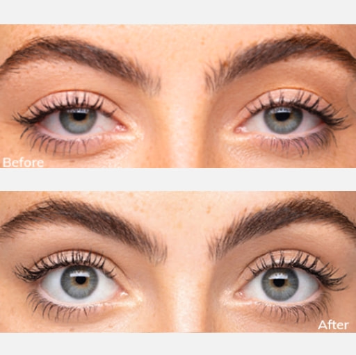 Before and after results of Upneeq eyelid treatment