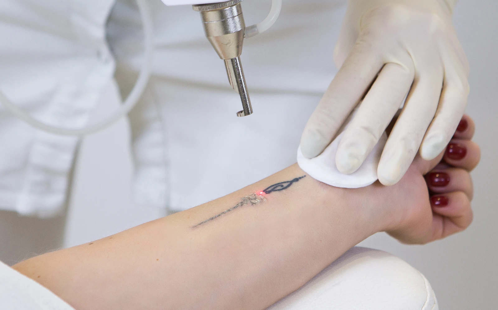 Tattoo removal treatment