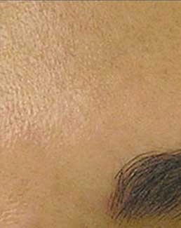 DBMS client after Hydrafacial treatment