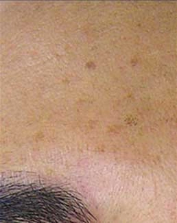DBMS client before Hydrafacial treatment