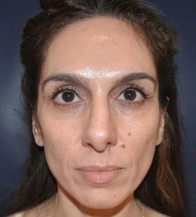 before sculptra