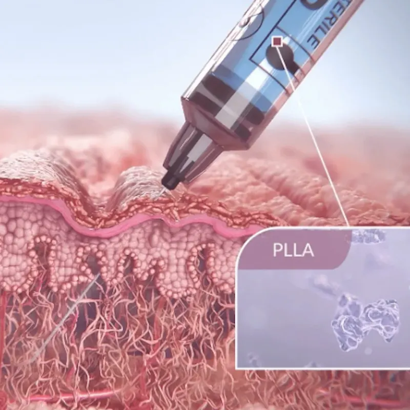 image showing how sculptra works in the skin