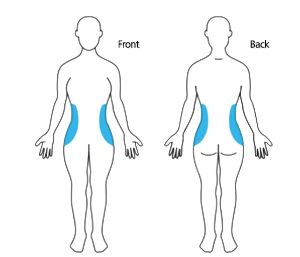 Coolsculpting Elite love handles treatment area