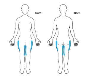 Coolsculpting Elite thighs treatment area