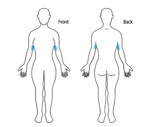 Coolsculpting Elite upper arms treatment area