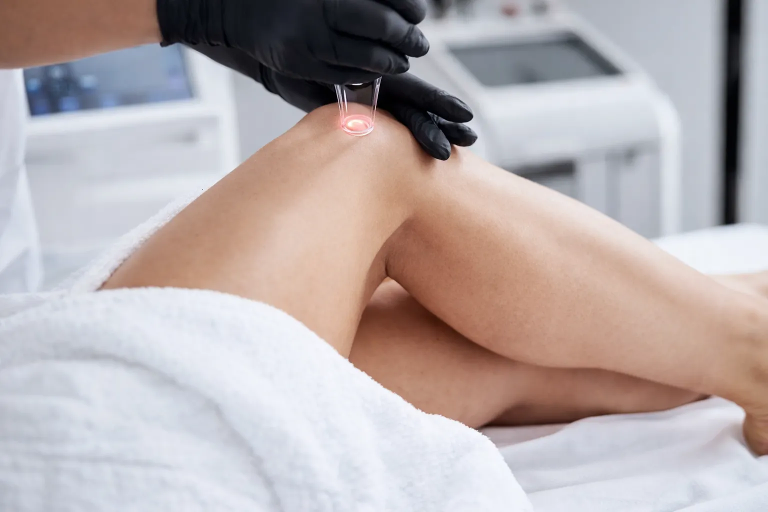 Laser treatment for patient's spider veins on legs