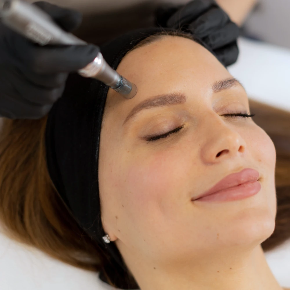 woman receiving microneedling treatment to improve skin texture and tone