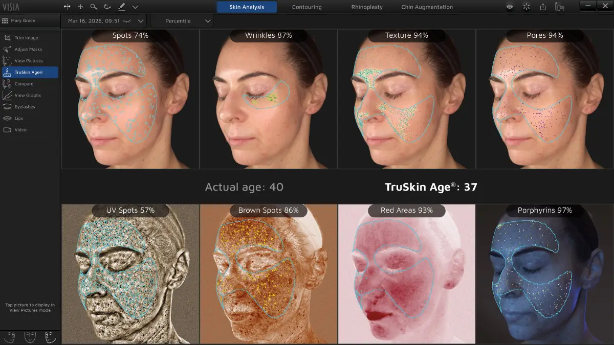 tru skin age from Visia complexion analysis