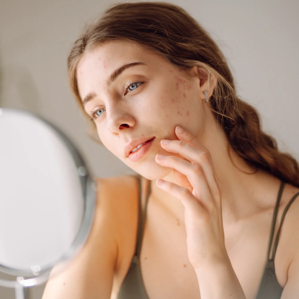 woman with acne