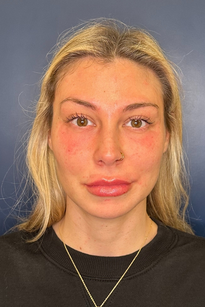 Patient 1 after photo