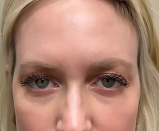 Patient 3 after photo