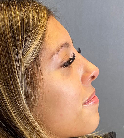 Patient 2 after photo