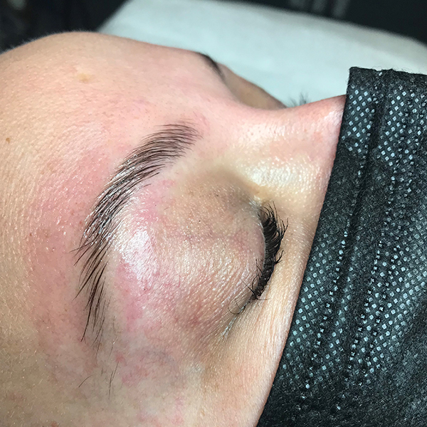 Patient 1 after photo