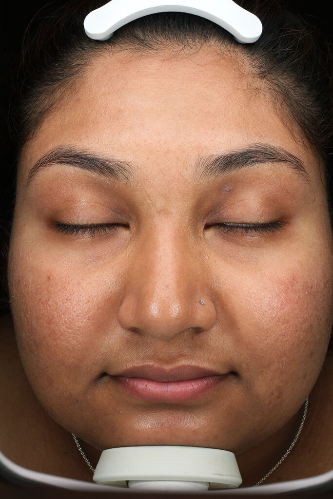 Patient 1 after photo