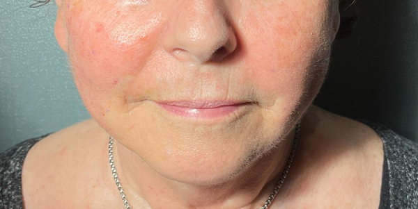 Patient 2 after photo