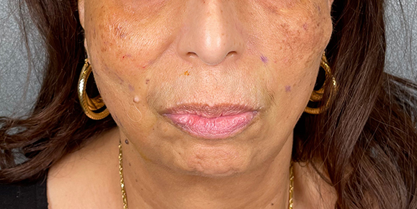 Patient 1 after photo