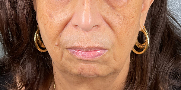 Patient 1 before photo