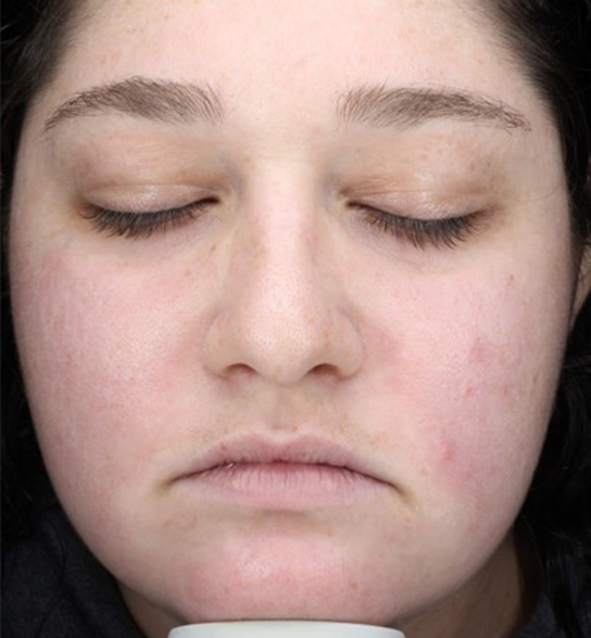 Patient 8 after photo