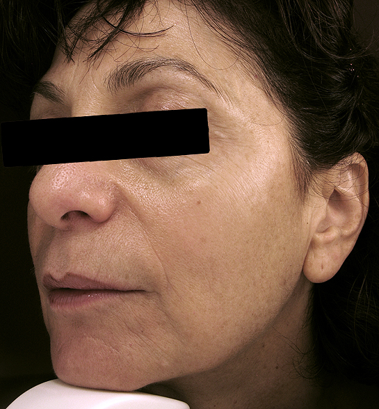 Patient 1 after photo