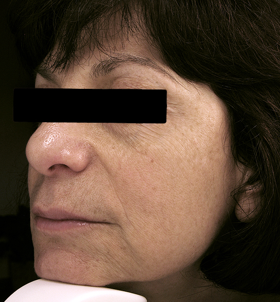 Patient 1 before photo