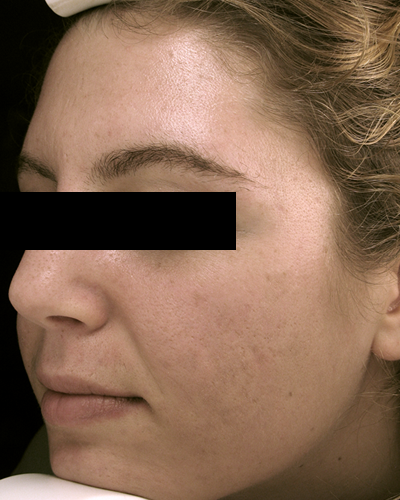 Patient 1 after photo