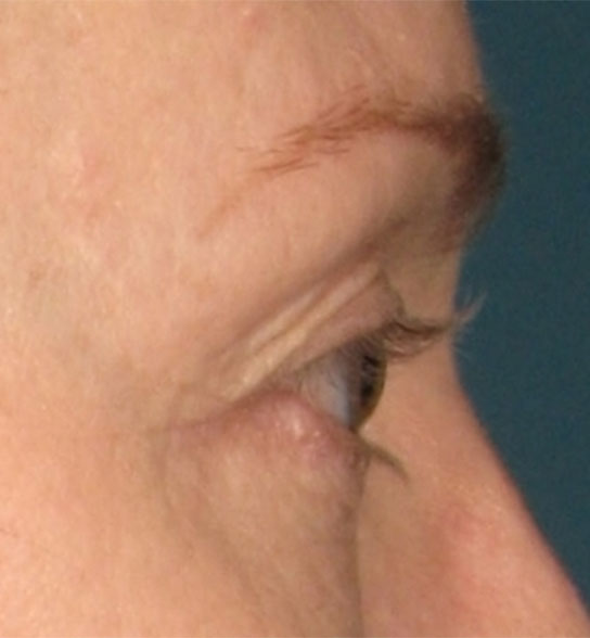 Patient 5 after photo