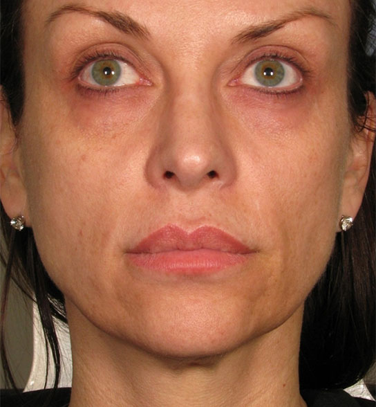 Patient 6 after photo