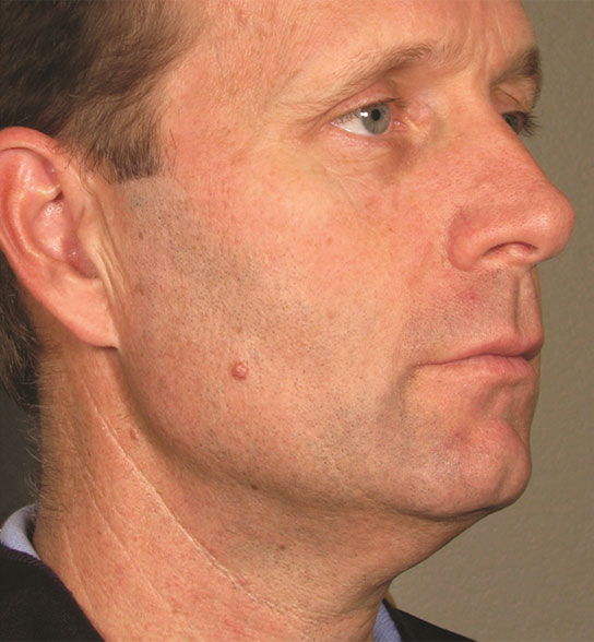 Patient 7 after photo