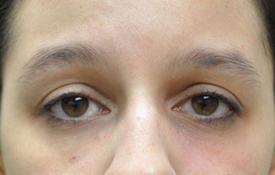 Patient 3 after photo