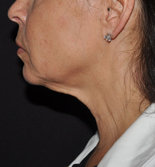 Patient 9 after photo