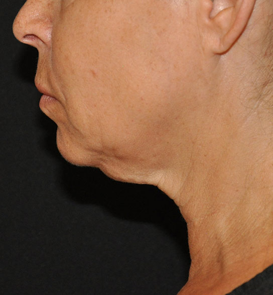 Patient 9 before photo