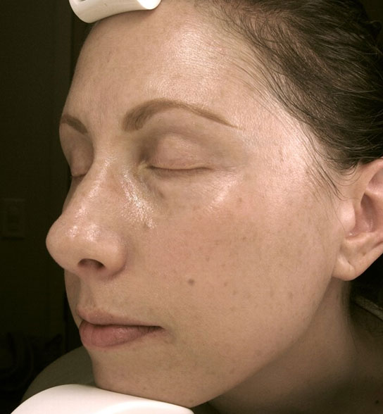 Patient 7 after photo