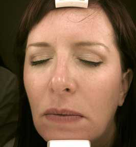 Patient 5 after photo