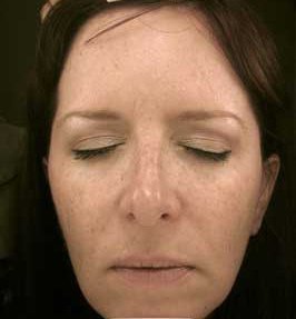 Patient 5 before photo