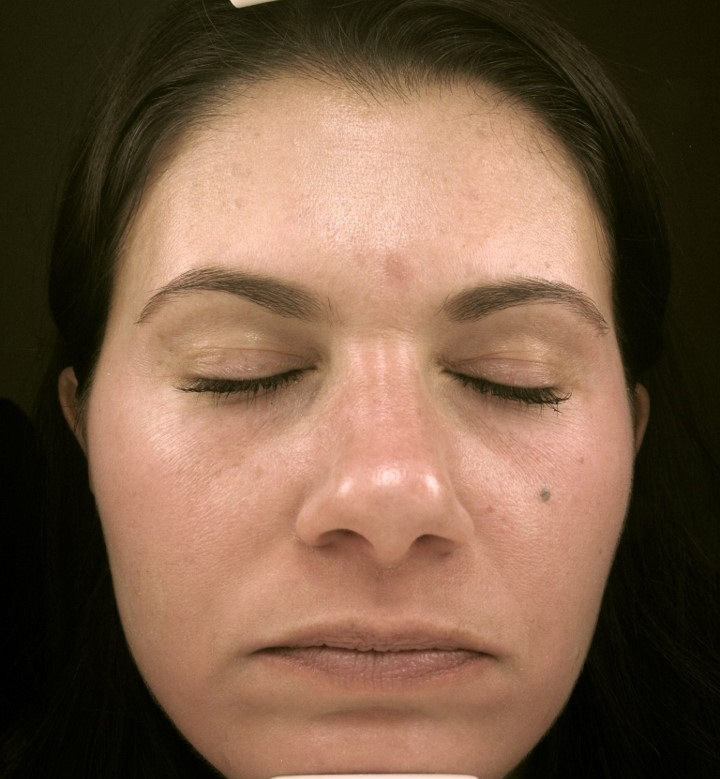 Patient 4 after photo