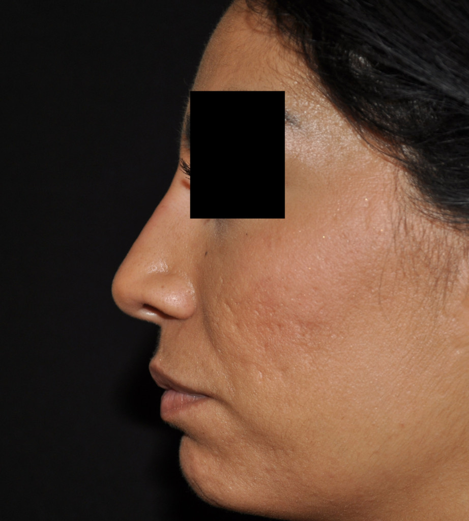 Patient 5 after photo