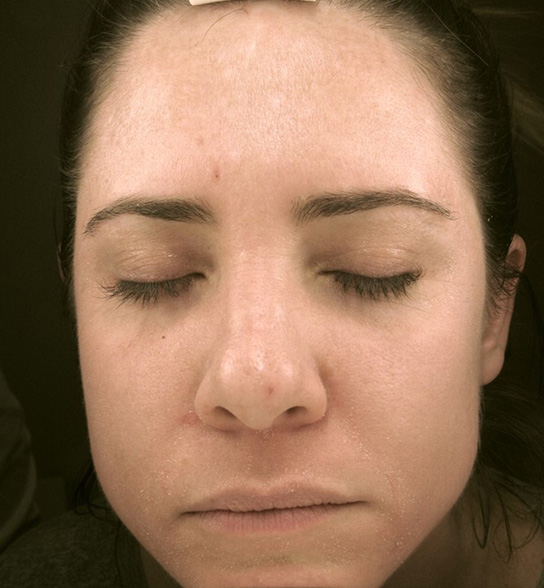 Patient 3 after photo