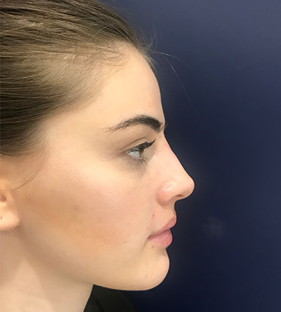 Patient 6 after photo