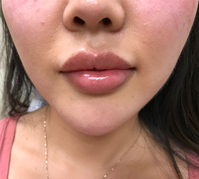 Patient 1 after photo