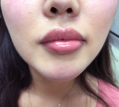 Patient 1 before photo